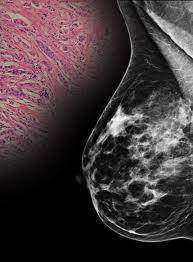 Xειρουργική αντιμετώπιση του καρκίνου του μαστού!