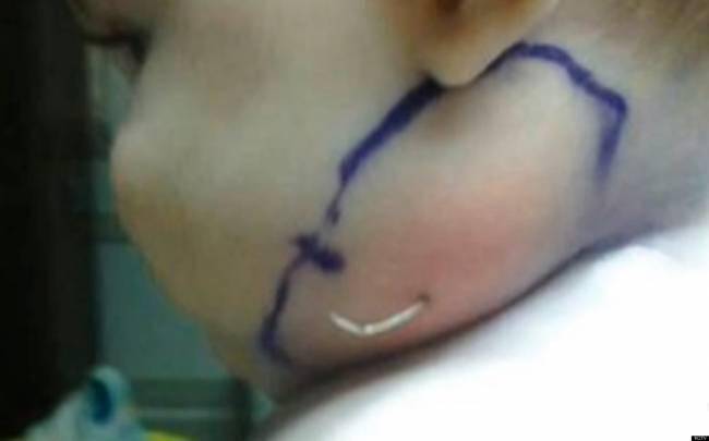 Απίστευτο: Γιατροί αφαίρεσαν από το πρόσωπο μωρού ένα φτερό!