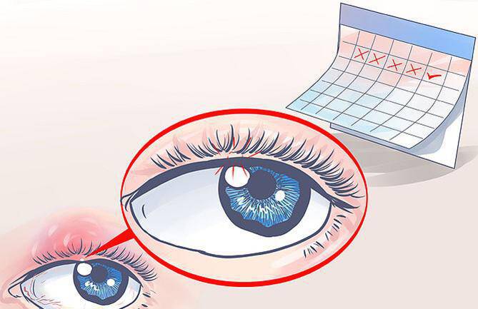 Κριθαράκι στο μάτι: Αντιμετώπιση σε 6 βήματα