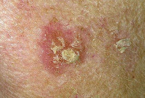 Καρκίνος του δέρματος: Τα προειδοποιητικά σημάδια σε φωτογραφίες