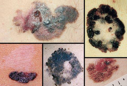 Καρκίνος του δέρματος: Οι 4 μορφές του σε φωτογραφίες