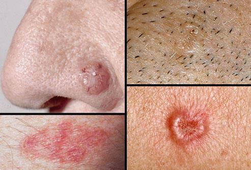 Καρκίνος του δέρματος: Οι 4 μορφές του σε φωτογραφίες