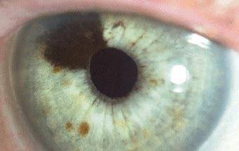 Καρκίνος στα μάτια: Αναγνωρίστε τα συμπτώματα μέσα από εικόνες