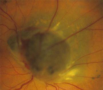 Καρκίνος στα μάτια: Αναγνωρίστε τα συμπτώματα μέσα από εικόνες