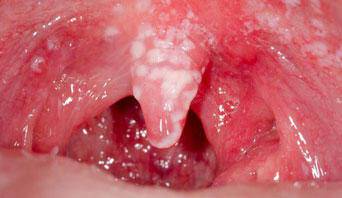 Μυκητίαση στο στόμα: Αίτια και συμπτώματα