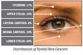 Ελιά στο μάτι ή το βλέφαρο: Πότε πρέπει να αφαιρείται