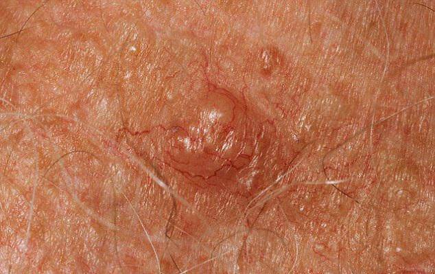 Καρκίνος του δέρματος: Δείτε ποια είναι τα συμπτώματα