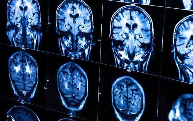 Τι πραγματικά κάνει η νόσος του Αλτζχάιμερ στον εγκέφαλο;
