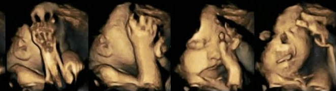 Πρώτη φορά σε εικόνες: Τι κάνει το κάπνισμα στο αγέννητο βρέφος μέσα στην μήτρα