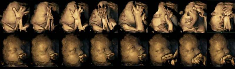 Πρώτη φορά σε εικόνες: Τι κάνει το κάπνισμα στο αγέννητο βρέφος μέσα στην μήτρα