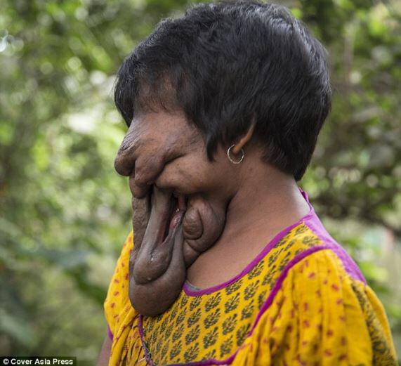 Η 21χρονη γυναίκα από την Ινδία που δεν έχει «πρόσωπο»!
