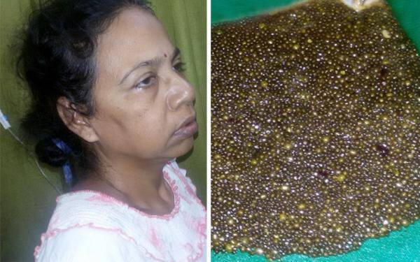 Αφαίρεσαν από γυναίκα 12.000 πέτρες χολής!Με το στόμα ανοιχτό έμεινε ο γιατρός