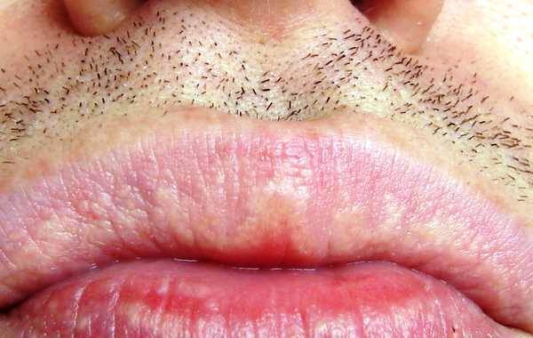 Λευκές κηλίδες στα χείλη: Ποιες σοβαρές ασθένειες καταδεικνύουν (φωτογραφίες)