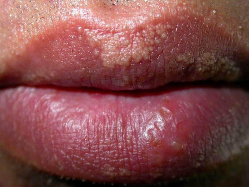 Λευκές κηλίδες στα χείλη: Ποιες σοβαρές ασθένειες καταδεικνύουν (φωτογραφίες)