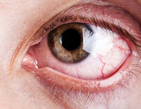 Θολούρα στα μάτια: Οι 6 πιθανές αιτίες