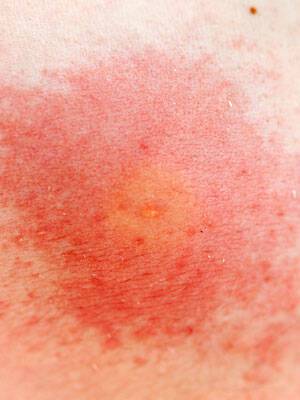 Τσιμπήματα εντόμων: Πώς θα ξέρετε τι σας τσίμπησε ανάλογα με το σημάδι στο δέρμα (φωτογραφίες)
