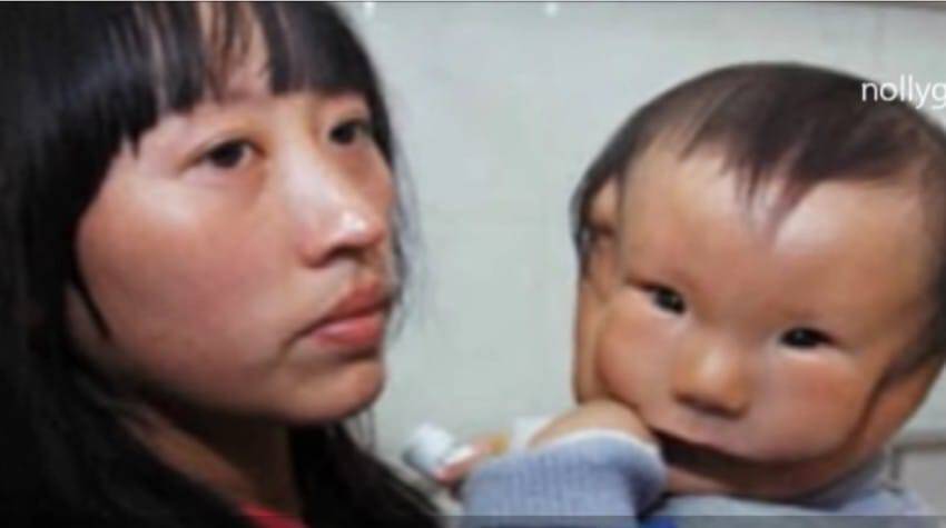 Η μάνα έβαλε τα κλάματα μόλις είδε το πρόσωπο του νεογέννητου μωρού της. Οι γιατροί δεν είχαν ξαναδεί ποτέ κάτι τέτοιο.