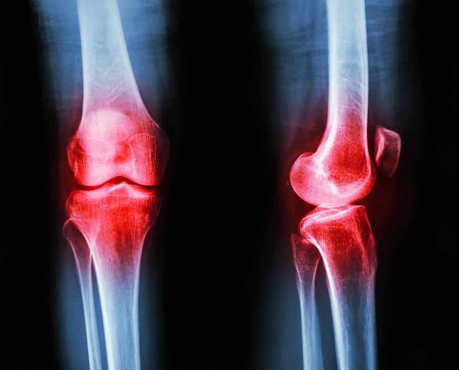 Πόνοι στα γόνατα: Κοινά προβλήματα και η αντιμετώπισή τους