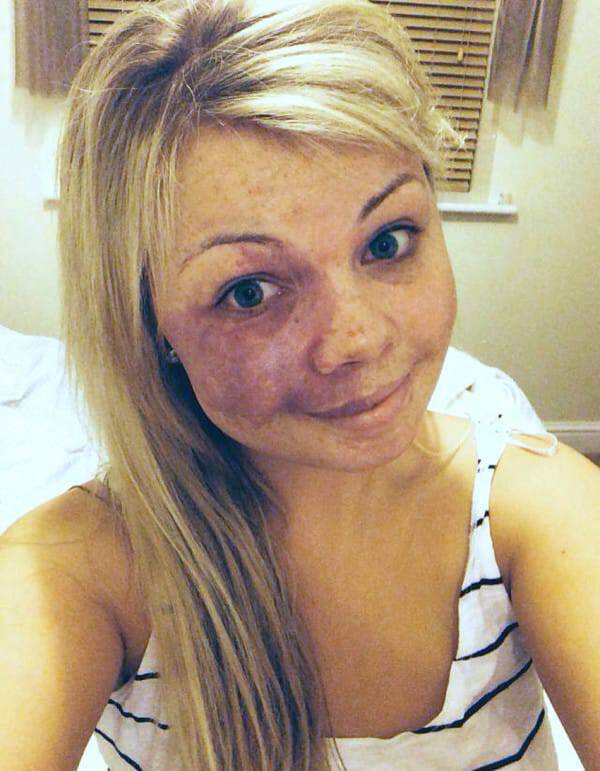 PIC FROM CATERS NEWS - (PICTURED: Amy Elsegood before she puts her makeup on.) - A beautiful woman with a birthmark covering half her face has launched a make-up vlog to share her impressive camouflage techniques. Amy Elsegood, 24, from Ripon, North Yorkshire, was diagnosed with a birthmark on her face commonly known as a port wine stain - shortly after birth. The purple coloured mark has caused Amy to be bullied and despite finally feeling comfortable in her own skin, she has decided to try and help others. After using special make-up since 11 years old to conceal her birthmark, Amy has now adopted her own techniques to make her face appear symmetrical and blemish free. Since launching her first video on Sunday (November 6) Amy has already received dozens of supportive messages. SEE CATERS COPY.