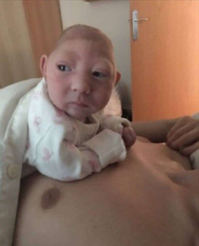 Γενναίο μωρό που γεννήθηκε με τον εγκέφαλο έξω από το κεφάλι, διαψεύδει τους γιατρούς και κερδίζει την πιο δύσκολη μάχη του.