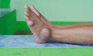 bigstock-Foot-Of-Gout-Patient-65286526