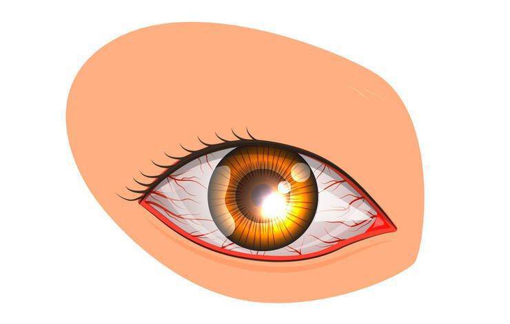Μάτια που κοκκινίζουν: 10 πιθανές αιτίες & τι να κάνετε