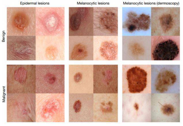 Καρκίνος του δέρματος: Διάγνωση ακριβείας από σύστημα Τεχνητής Νοημοσύνης [pics]