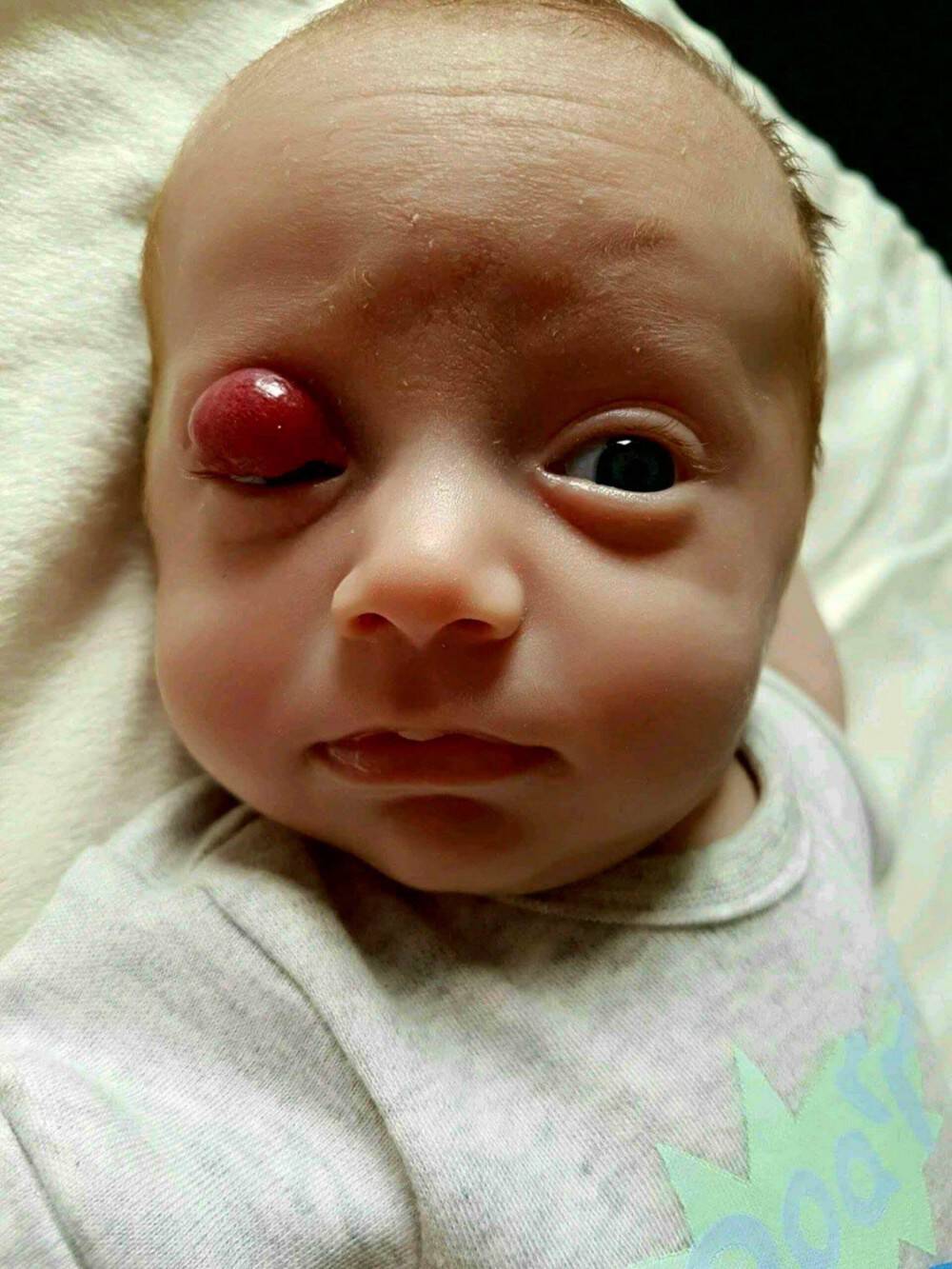 Το πρόωρο μωρό τους γεννήθηκε με έναν μεγάλο όγκο στο μάτι. Όταν οι γιατροί τους απογοήτευσαν, δεν έχασαν την πίστη τους και πέτυχαν το ανέλπιστο!