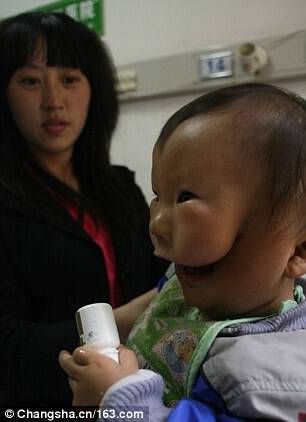 Ραγίζει καρδιές το παιδί «μάσκα»! Φαίνεται να έχει δυο πρόσωπα από μια σπάνια γενετική διαταραχή