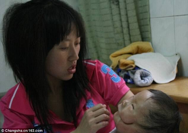 Ραγίζει καρδιές το παιδί «μάσκα»! Φαίνεται να έχει δυο πρόσωπα από μια σπάνια γενετική διαταραχή