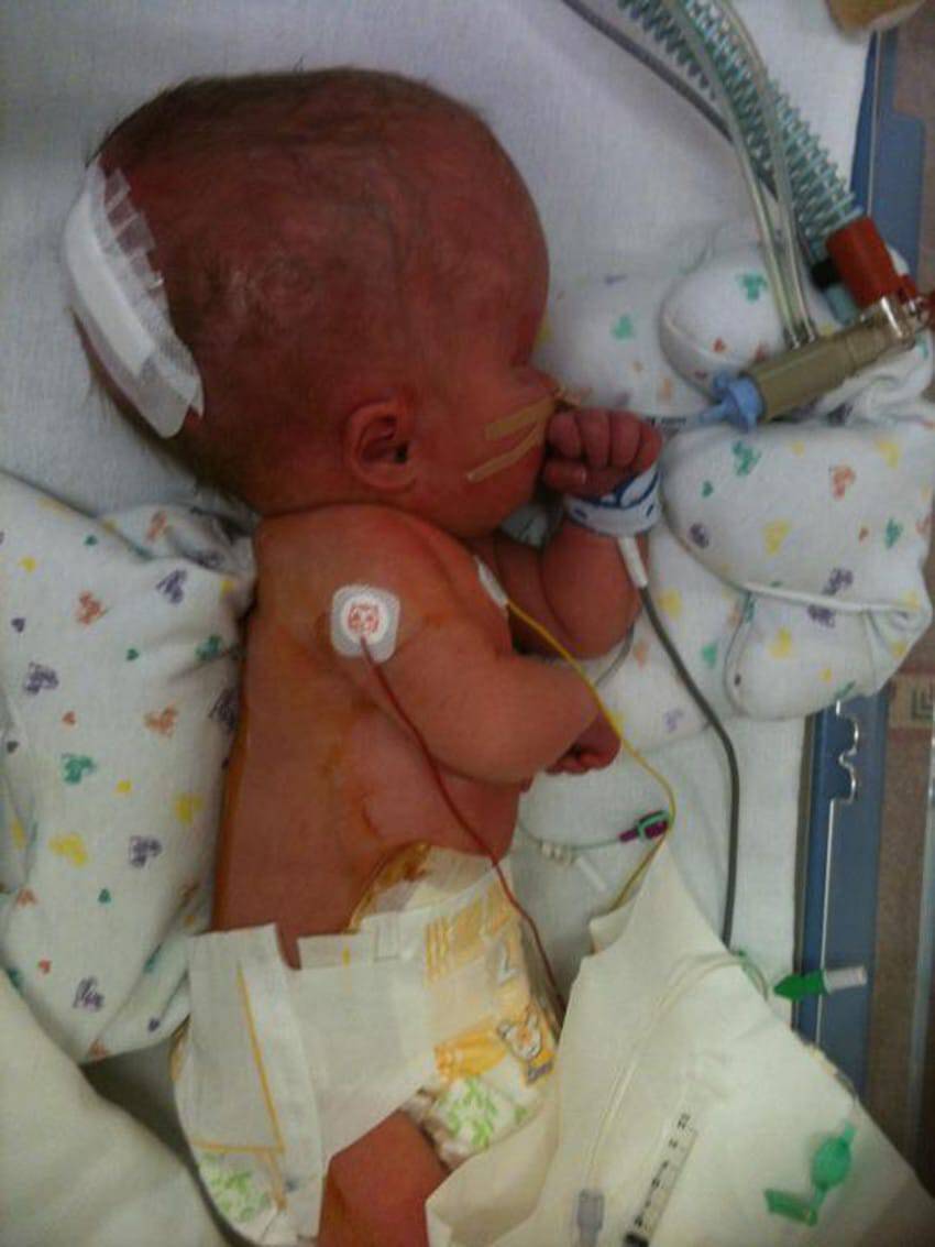 Μωρό που γεννήθηκε 4 χρόνια πριν «χωρίς εγκέφαλο» εκπλήσσει σήμερα τους γιατρούς όταν το μυαλό του αρχίζει να μεγαλώνει