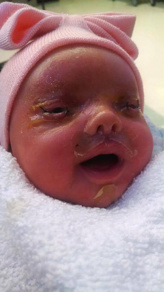 Νεαρή μητέρα γεννάει ένα κοριτσάκι αλλά οι γιατροί τρομάζουν μόλις βλέπουν ότι το δέρμα του μοιάζει με «πλαστικό περιτύλιγμα»