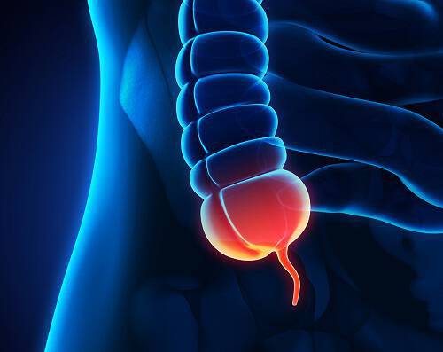 Τέσσερα συμπτώματα σκωληκοειδίτιδας πέρα από τον πόνο στην κοιλιά