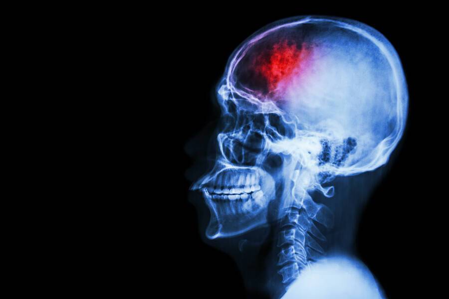 Αρρυθμίες: Πόσο αυξάνουν τον κίνδυνο εγκεφαλικού