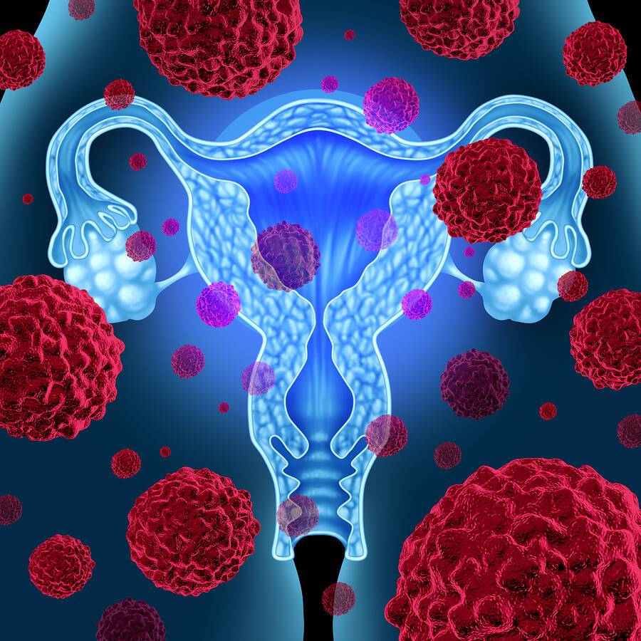 Γυναικολογικοί καρκίνοι: 5 προειδοποιητικά σημάδια που πολλές γυναίκες αγνοούν