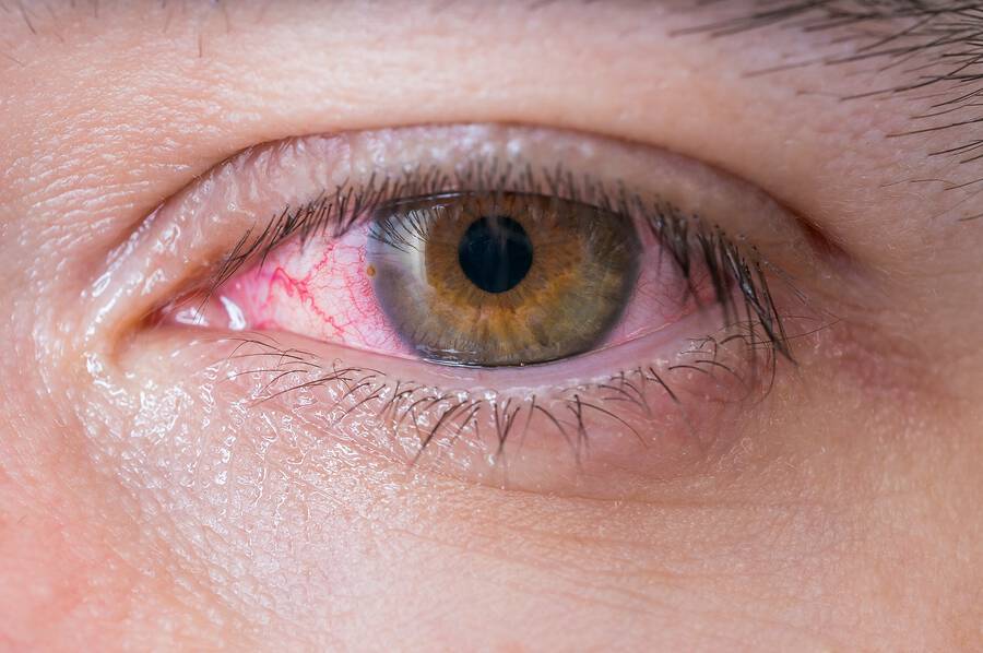 Εαρινή αλλεργική επιπεφυκίτιδα: Πώς θα ανακουφιστείτε από τα συμπτώματα