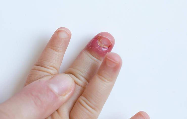 Τρώτε τα νύχια σας; Οι 7 κίνδυνοι για την υγεία σας