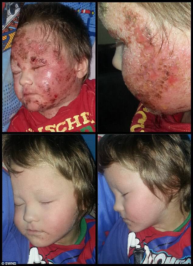 Τρομερό έκζεμα σε 5χρονο: Έγδερνε το δέρμα του επειδή εθίστηκε στα στεροειδή της αλοιφής [pics, vid]