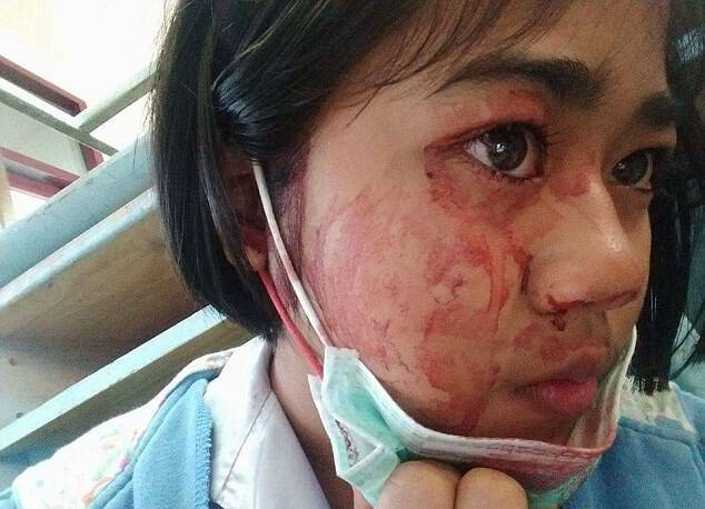 ΣΟΚ: 7χρονη αιμορραγεί από μάτια, μύτη, αυτιά και δέρμα κάθε φορά που έχει πονοκέφαλο – Τι είναι η αιματοΐδρωση [pics, vid]