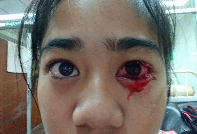 ΣΟΚ: 7χρονη αιμορραγεί από μάτια, μύτη, αυτιά και δέρμα κάθε φορά που έχει πονοκέφαλο – Τι είναι η αιματοΐδρωση [pics, vid]
