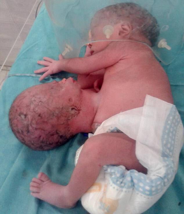 ΣΟΚ με μωρό που γεννήθηκε με δεύτερο κεφάλι κολλημένο στο στομάχι του! [pics]