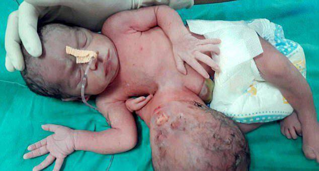Μωρό στην Ινδία γεννήθηκε με ένα δεύτερο κεφάλι κολλημένο στο στομάχι του