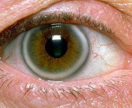 Υψηλή χοληστερίνη: Το σημάδι στα μάτια που δείχνει ανεβασμένη χοληστερόλη [pics]