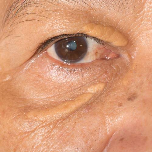 Υψηλή χοληστερίνη: Το σημάδι στα μάτια που δείχνει ανεβασμένη χοληστερόλη [pics]