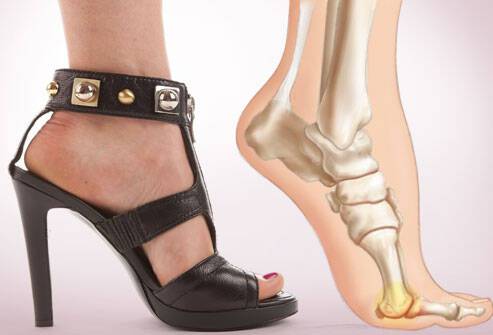 Προσοχή με τα τακούνια: Τι παθαίνουν τα πόδια &#8211; Χρόνια προβλήματα
