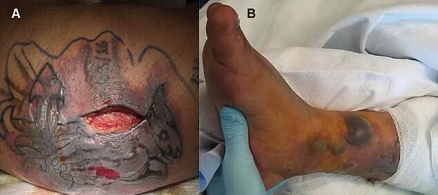 ΣΟΚ: Νεκρός 31χρονος από σαρκοφάγο βακτήριο – Μολύνθηκε το φρέσκο τατουάζ του – ΠΡΟΣΟΧΗ!