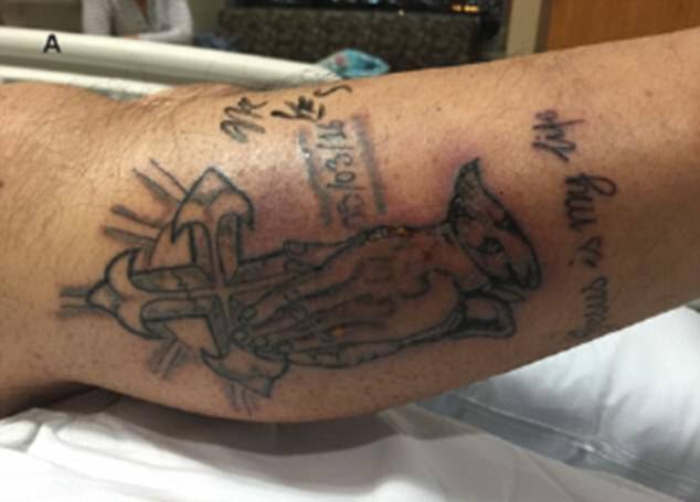 ΣΟΚ: Νεκρός 31χρονος από σαρκοφάγο βακτήριο – Μολύνθηκε το φρέσκο τατουάζ του – ΠΡΟΣΟΧΗ!