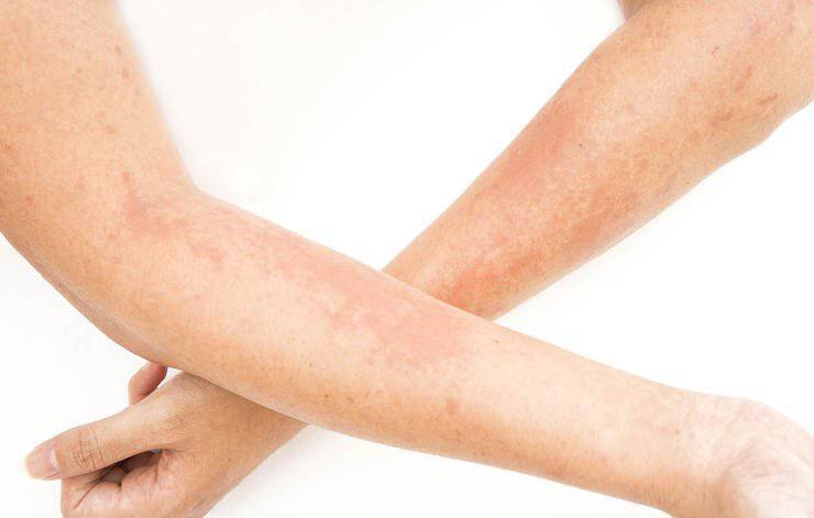 Εποχικές αλλεργίες: 7 σημάδια ότι είναι πιο σοβαρές απ’ ότι νομίζετε