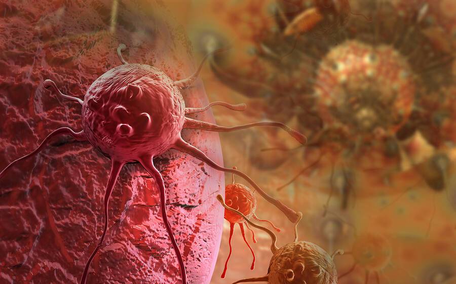 Περιοδοντική νόσος: Με ποιες μορφές καρκίνου συνδέεται