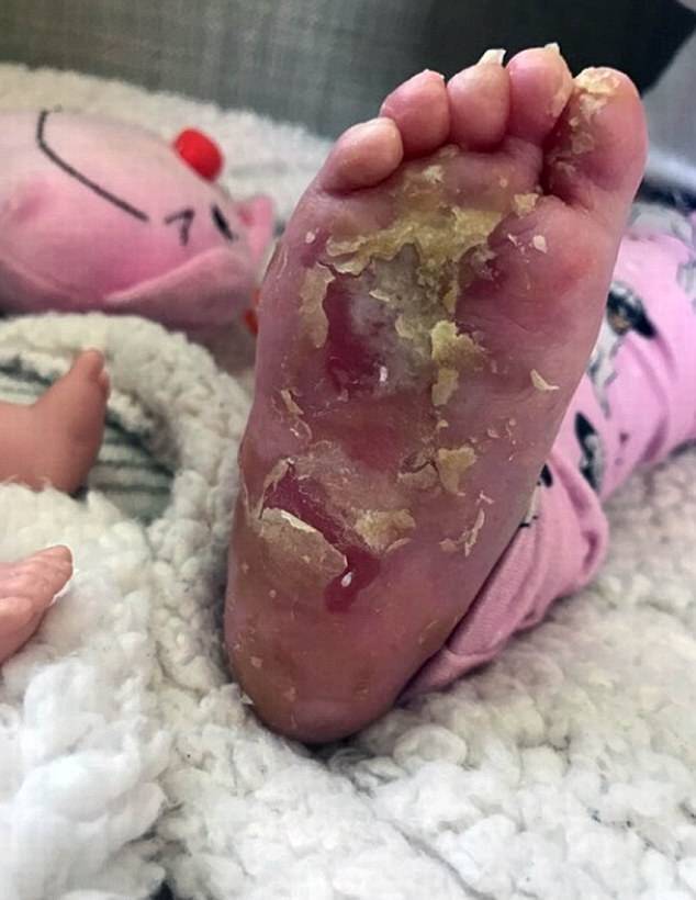Το Facebook απαγόρευσε φωτογραφία παιδιού με δερματική ασθένεια – Προκαλεί αντιδράσεις η δικαιολογία που έδωσε [pics]